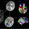 На нем показано сканирование мозга в перинатальный период с выделением областей, связанных с аутизмом.